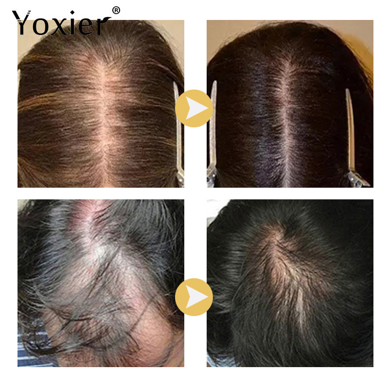 Intensive Growth Serum Prevent - đánh giá và giá Hair Care For Hair Growth